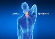Cervical Spondylosis DwarkeshAyuerved.com